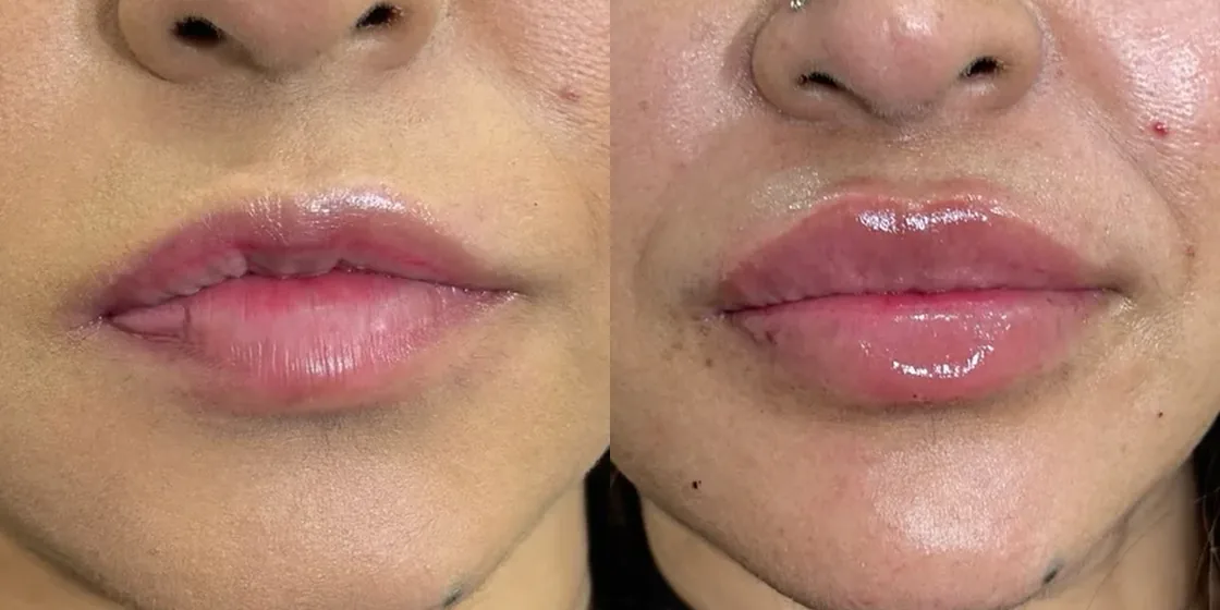 A lip filler before and after at Contour Aesthetics, Greenpoint Brooklyn