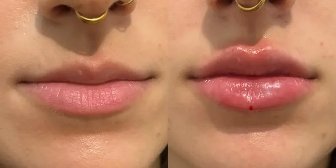 A lip filler before and after at Contour Aesthetics, Greenpoint Brooklyn