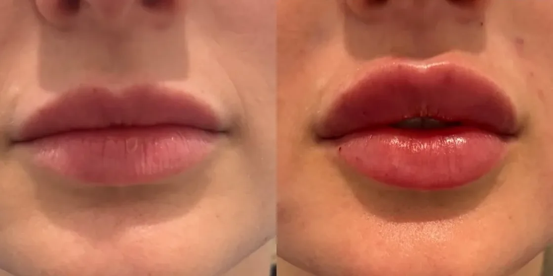 A lip filler before and after at Contour Aesthetics, Greenpoint Brooklyn