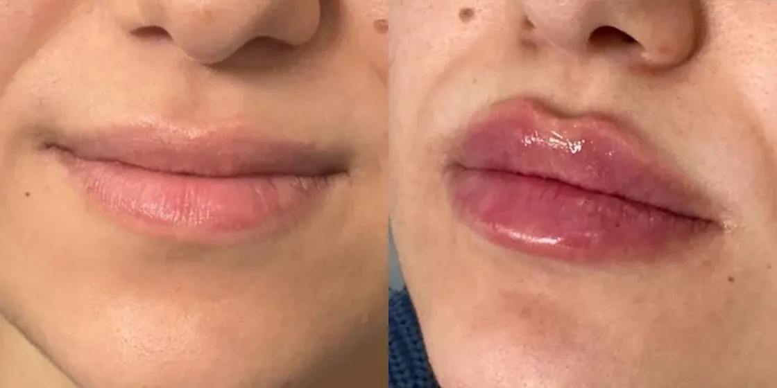 A lip filler before and after at Contour Aesthetics, Greenpoint Brooklyn