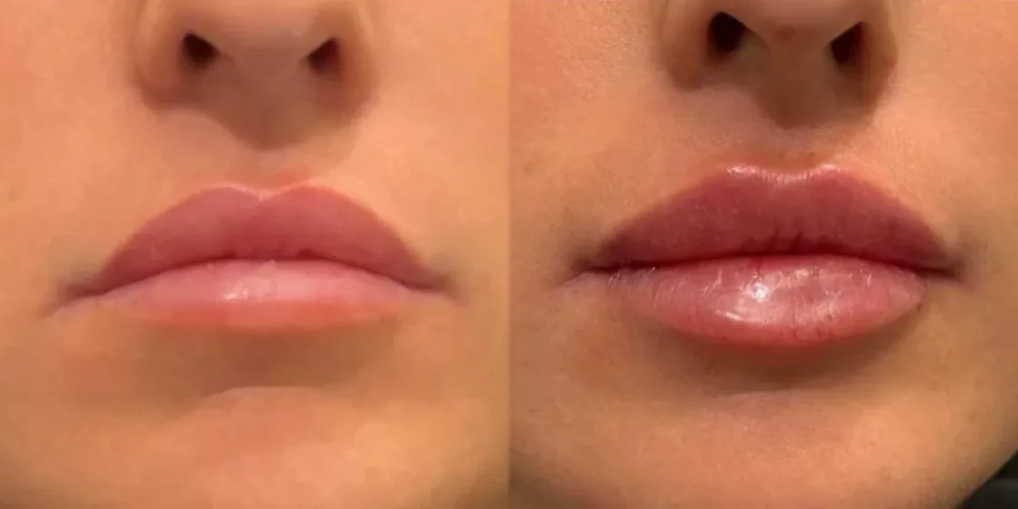 A lip filler before and after at Contour Aesthetics, Greenpoint Brooklyn