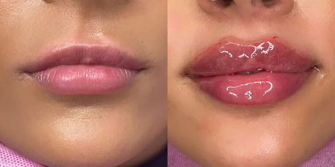 A lip filler before and after at Contour Aesthetics, Greenpoint Brooklyn