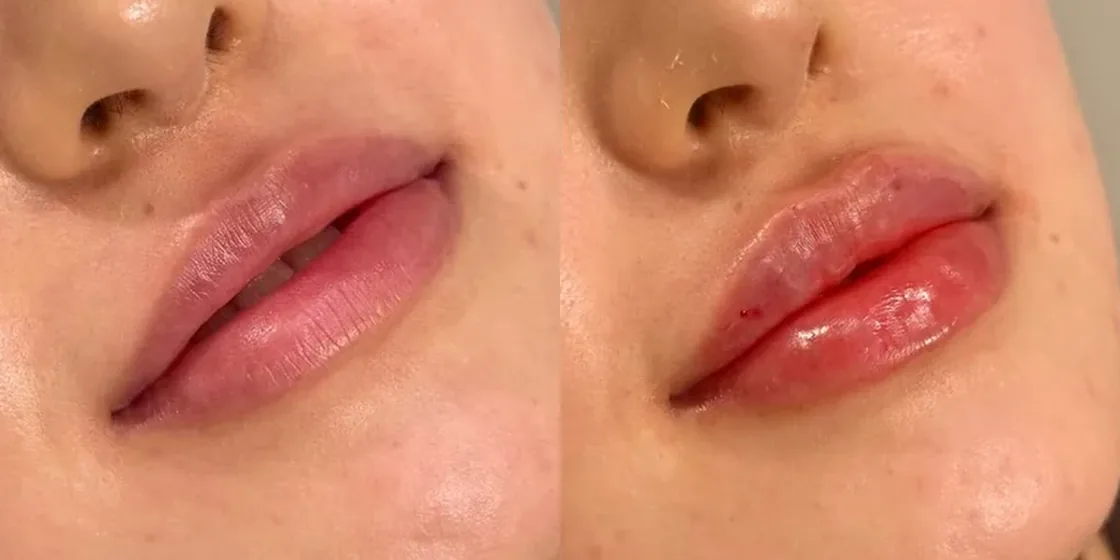 A lip filler before and after at Contour Aesthetics, Greenpoint Brooklyn