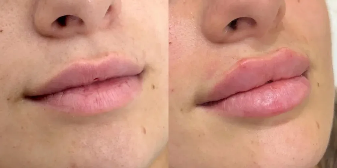 A lip filler before and after at Contour Aesthetics, Greenpoint Brooklyn