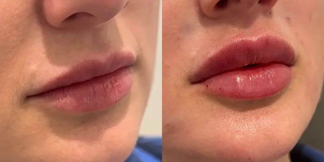 A lip filler before and after at Contour Aesthetics, Greenpoint Brooklyn