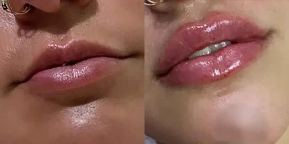 A lip filler before and after at Contour Aesthetics, Greenpoint Brooklyn